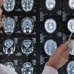 Traumatic Brain Injury Attorneys in Lakewood