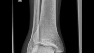 Castle Rock Semi-Truck Accident Shuts Down Northbound I-25