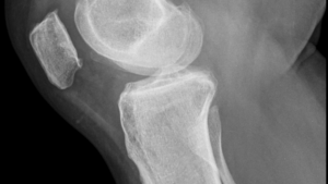 Injuries Commonly Seen in a Denver Slip and Fall Accident